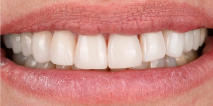 bright white smile after cosmetic treatment