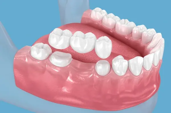 dental bridges in marpole vancouver