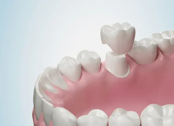 dental crowns in marpole vancouver