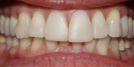 dental discoloration before cosmetic treatment