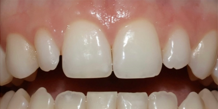 dental flaws before treatment
