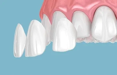 porcelain veneers in marpole vancouver