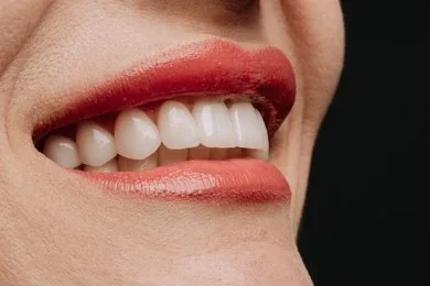 porcelain veneers near you