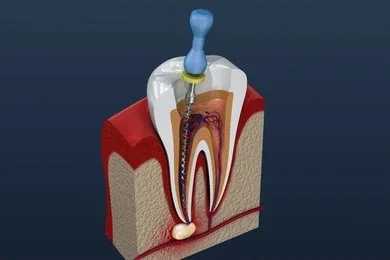 root canal therapy in marpole vancouver