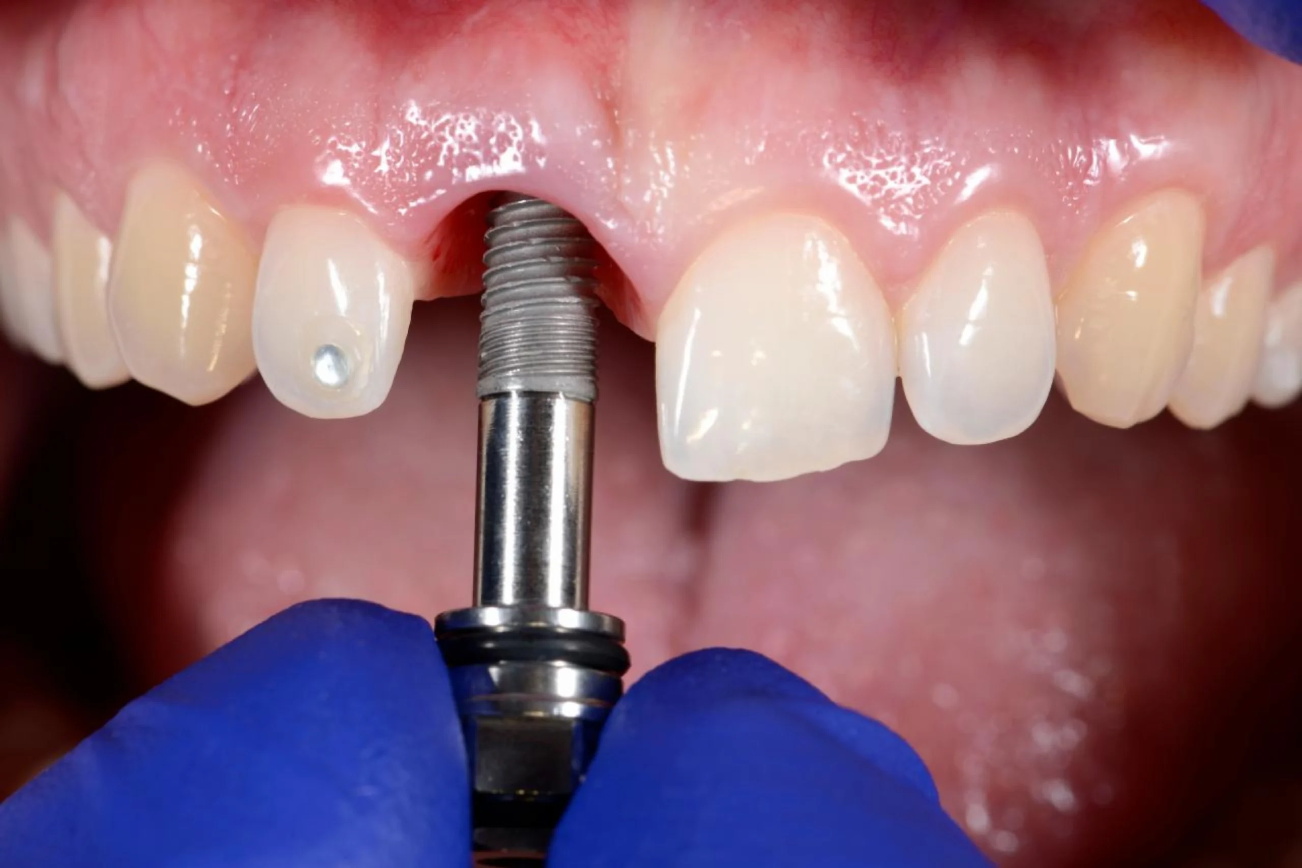 single tooth implants in marpole vancouver