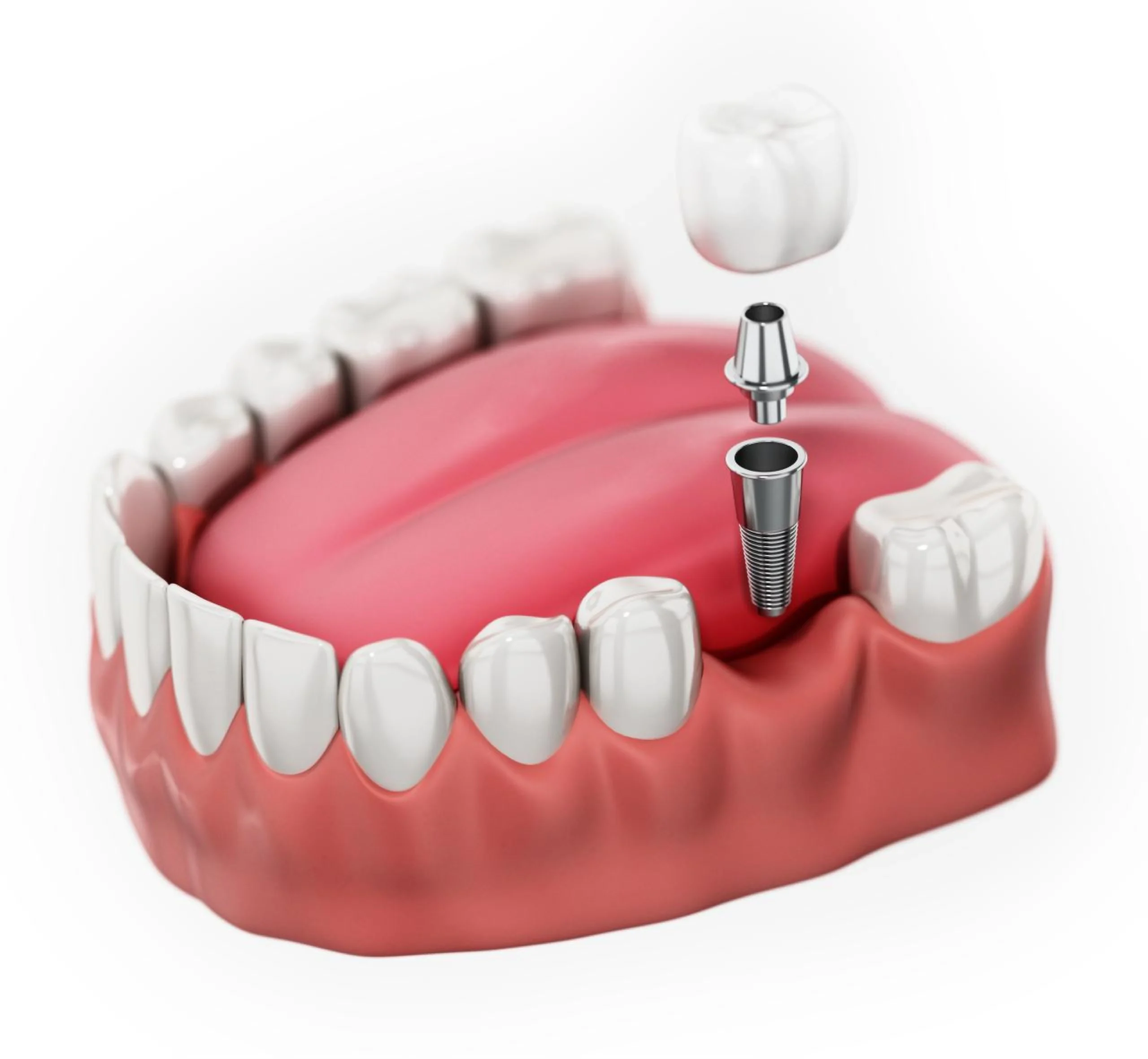 single tooth implants near you
