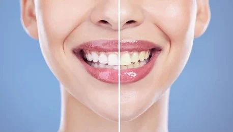 teeth whitening near you