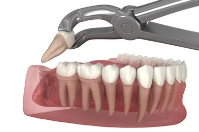 tooth extractions near you