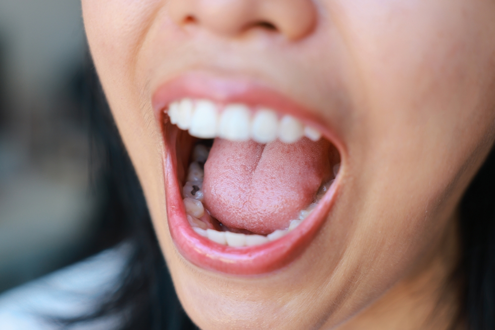 white dental fillings in marpole vancouver