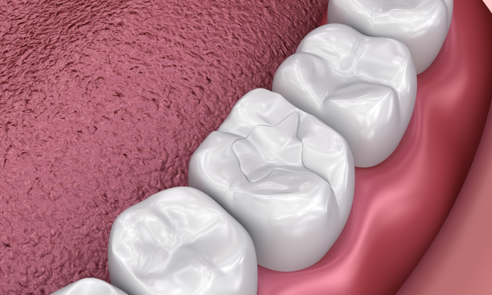 white dental fillings near you